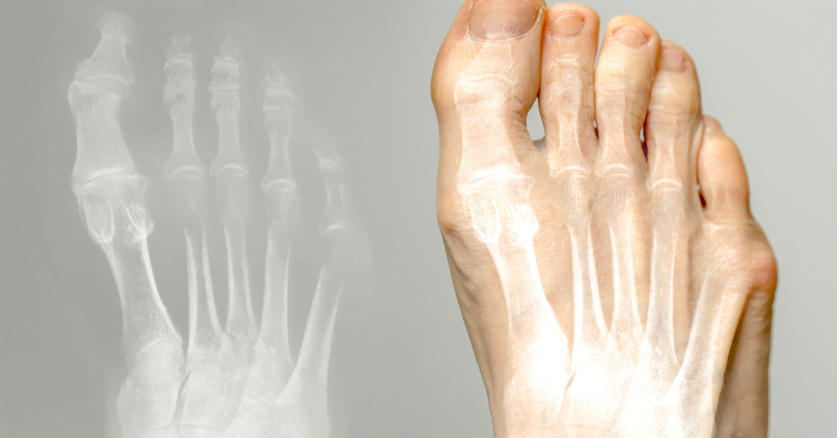 Tratamiento del hallux valgus – separador de dedos y calzado
