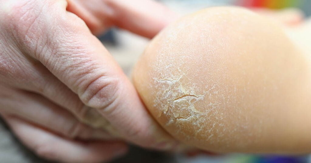 Grietas en los talones – fisuras y grietas en la piel del talón