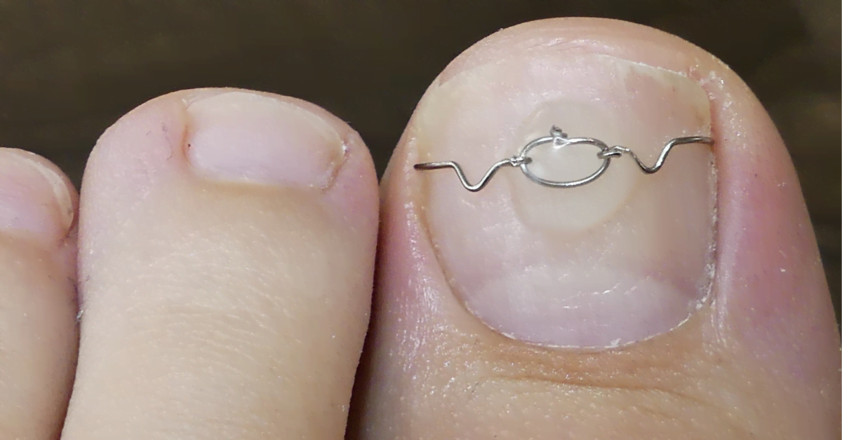 Uña encarnada – tratamiento y prevención