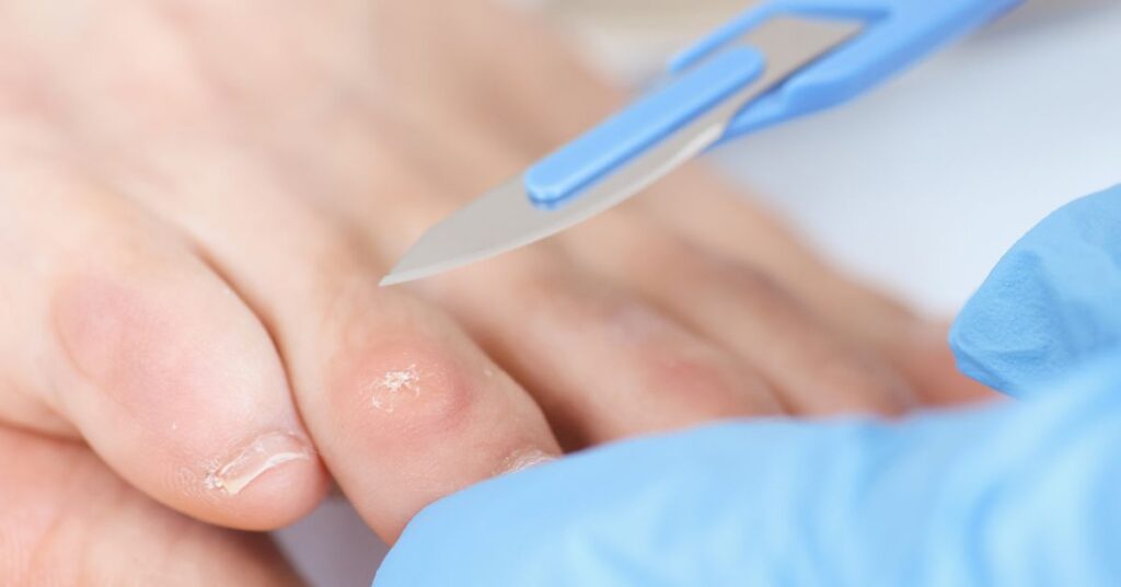 Callosidad – ojo de gallo en el pie