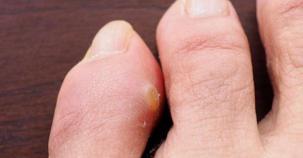 Tratamiento de callosidad – podólogo y prevención