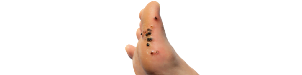 Verruga plantar – verruca plantaris en la planta del pie